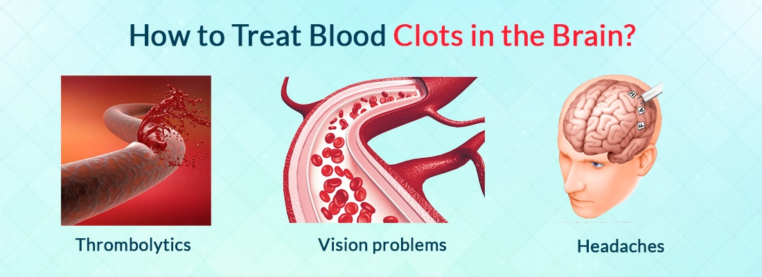 How to Treat Blood Clots in the Brain